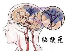 脑梗塞 脑梗塞