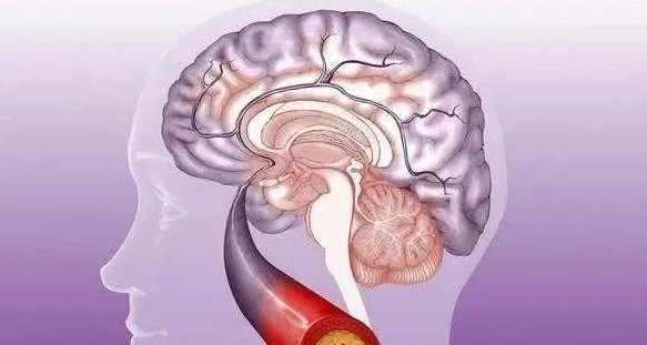 脑梗，杭州英智康复